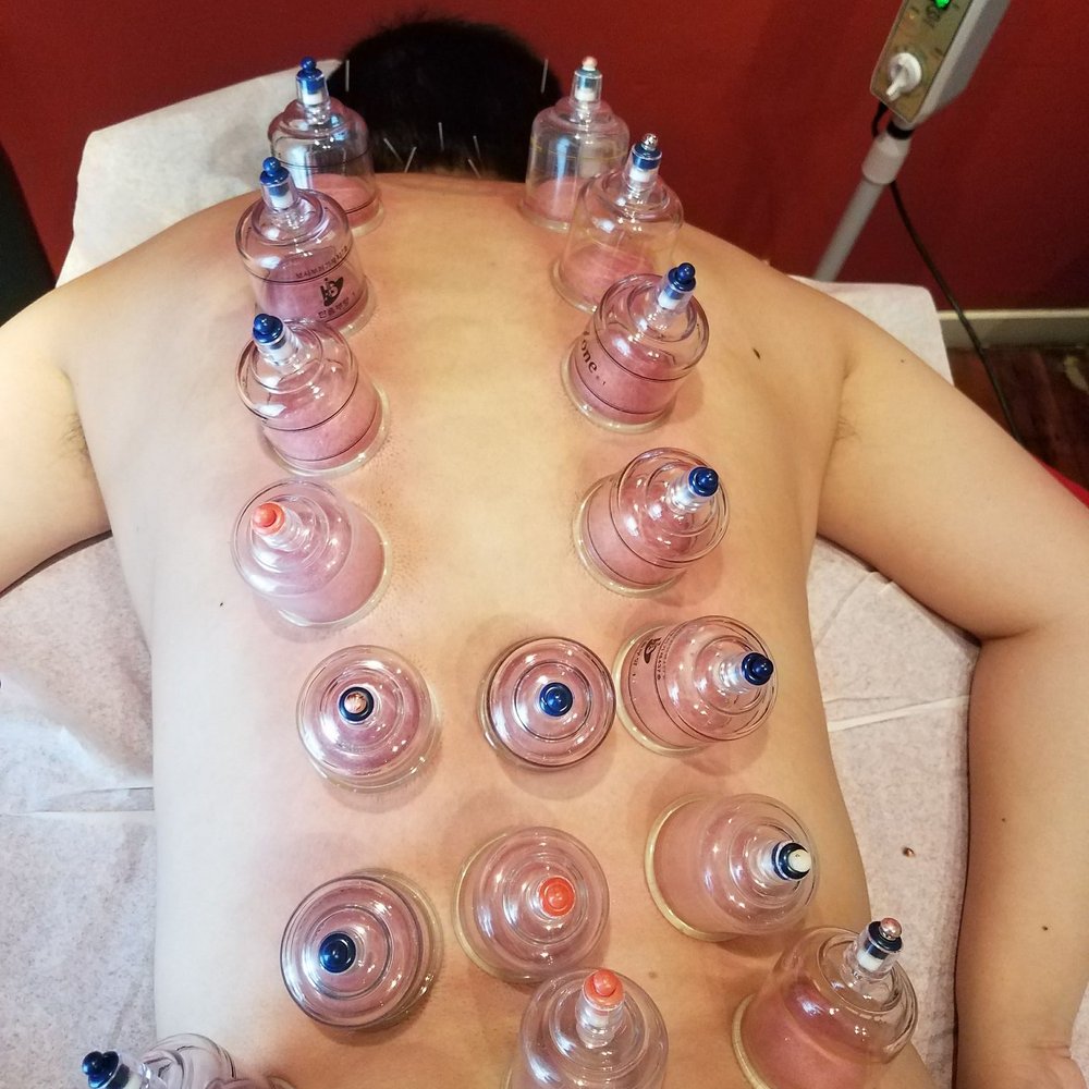 Oakland Community Acupuncture - Cupping for back pain - Acupuncture Near Me - Oakland, California Oakland Community Acupuncture - Cupping for back pain - Acupuncture Near Me - Oakland, California