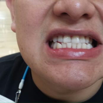 DaVinci Teeth Whitening System - Teeth Whitening Near Me - Henderson, Nevada