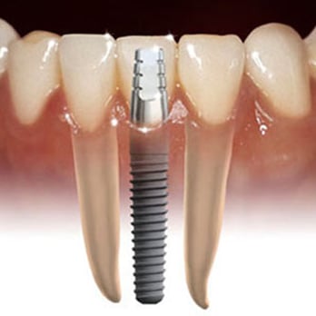 Justin C Wright, DDS - Just Wright Dental - Tooth replacement with Implants Using IV Sedation - Cosmetic Dentists Near Me - Corsicana, Texas Justin C Wright, DDS - Just Wright Dental - Tooth replacement with Implants Using IV Sedation - Cosmetic Dentists Near Me - Corsicana, Texas