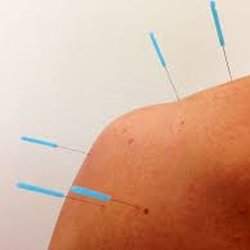 Yin Studio - Acupuncture is perfect for muscle pain