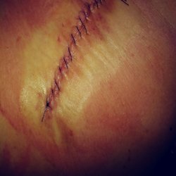 Adam Lipson, MD - 36 hr post op. Swollen(still is a month later). The only difference.stitches out.and not as red. This is the abdomen. My back scar looks ok.