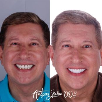 Skoulas, DDS - Before and after photos - Cosmetic Dentists Near Me - San Francisco, California