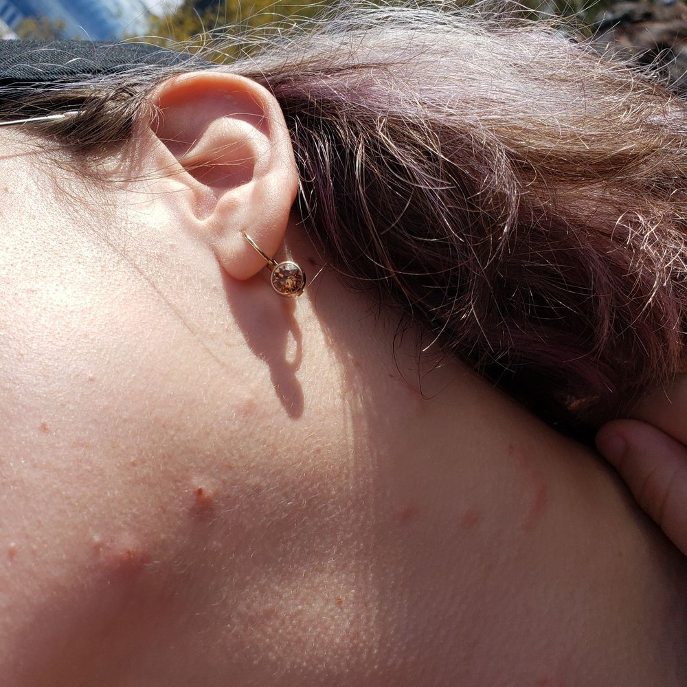 Bed bug bites Bed bug bites