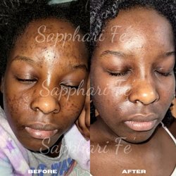 Sapphari Fe' Facial Spa & Beauty Bar - Acne & Hyperpigmentation Treatment (2months)