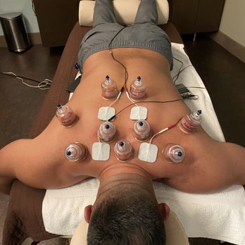 Active Body Chiropractic - Mixed Therapy , Cupping with Electric Muscle Stimulation - Chiropractors Near Me - Hawthorne, California