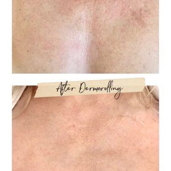 Dermaplus Skin + Body - Results 6 weeks after 1 dermarolling session on chest - Skin Care Near Me - San Francisco, California Dermaplus Skin + Body - Results 6 weeks after 1 dermarolling session on chest - Skin Care Near Me - San Francisco, California