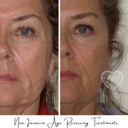 Intown Smile Studio - Non-invasive age reversing treatments (actual patient)