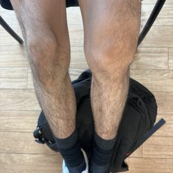 Concentra - Broken knee