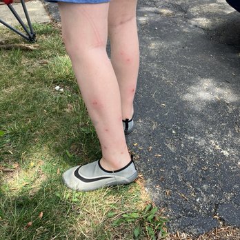 Apple Tree Inn - Son's legs covered in flea bites - Hotels Near Me - Spokane, Washington