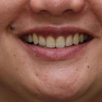 Chris Chen Orthodontics - After photo, more evenly spaced teeth. I might need to get my teeth whitened, though. The trays really did a number on my teeth. - Orthodontists Near Me - Monterey Park, California