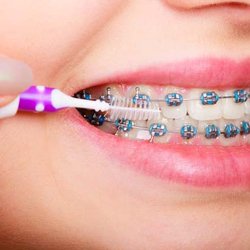 Aces Braces