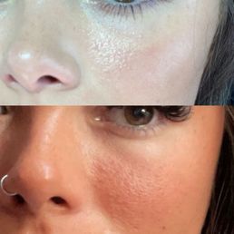 One session of microneedling top is after treatment was done One session of microneedling top is after treatment was done