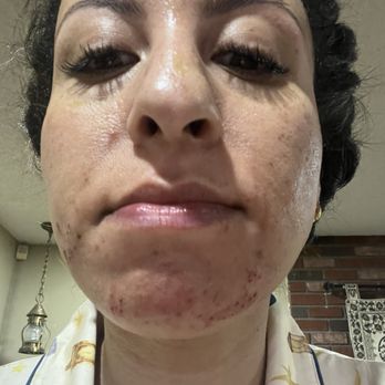 Simi's Threading - Waxing burns - Waxing Near Me - Redlands, California Simi's Threading - Waxing burns - Waxing Near Me - Redlands, California