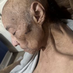 Pilgrim Manor - Facial bruising from falling white drugged.