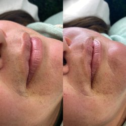 Xposed Waxing Salon - Upper Lip and Chin Wax