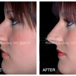 MilfordMD Cosmetic Dermatology Surgery & Laser Center - Before and After Non-Surgical Rhinoplasty - MilfordMD
