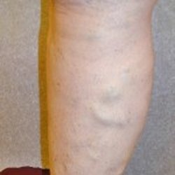 James McPherson, MD - Marina Del Rey Vein & Vascular Center - Before #3
