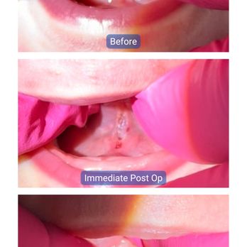 Lovebee Pediatric Dentistry - Laser tongue-tie release using CO2 laser - Pediatric Dentists Near Me - Tustin, California Lovebee Pediatric Dentistry - Laser tongue-tie release using CO2 laser - Pediatric Dentists Near Me - Tustin, California