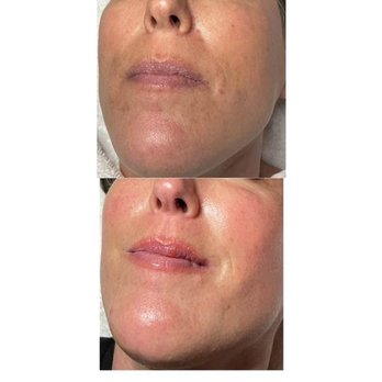 Radiance Day Spa - UltraSilk Facial Treatment - Skin Care Near Me - Yuba City, California Radiance Day Spa - UltraSilk Facial Treatment - Skin Care Near Me - Yuba City, California
