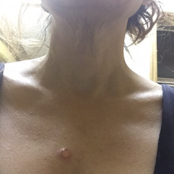 Bingham Dermatology Group - Blister! Turned into scar! - Dermatologists Near Me - Mesa, Arizona Bingham Dermatology Group - Blister! Turned into scar! - Dermatologists Near Me - Mesa, Arizona