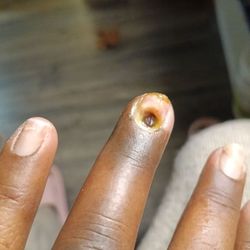 Elegant Nails & Tan - This is what this is when I lost my nail to infection. Horrible pain as well