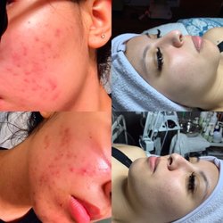Client's Before & After photo. Purchase skin care products online with FREE shipping at www.morriscodebeauty.com
