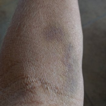 Sonora Quest Laboratories - Pic taken one full week after an inept phlebotomist attempted to draw my blood at the Summit office of Sonora Quest Labs. - Laboratory Testing Near Me - Scottsdale, Arizona Sonora Quest Laboratories - Pic taken one full week after an inept phlebotomist attempted to draw my blood at the Summit office of Sonora Quest Labs. - Laboratory Testing Near Me - Scottsdale, Arizona