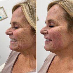 Taren Nicole Aesthetics - Dermal Filler for Laugh Lines around the mouth