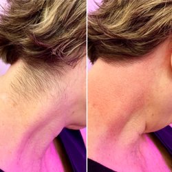 Sweet Cheeks - Before and after of neck sugar hair removal
