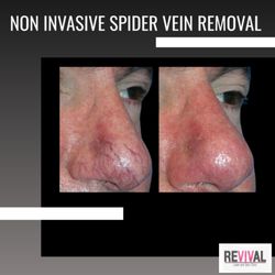 REVIVAL Laser and Skin Clinic - Spider Vein Removal using the most advanced technology on the market!