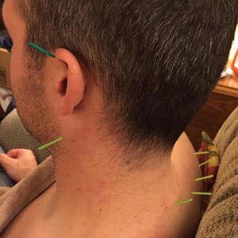 Virginia BodyWork - Acupuncture Near Me - Herndon, Virginia Virginia BodyWork - Acupuncture Near Me - Herndon, Virginia