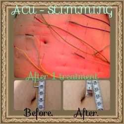 AcuBethel Acupuncture & Herbs - Acu - Slimming !