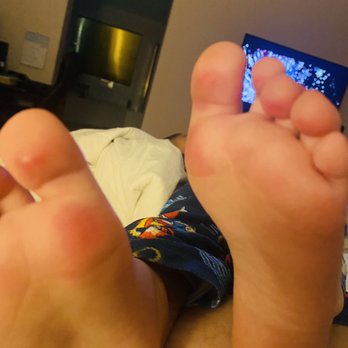 Joe Wilson Pool - My grandson feet 1 day later . - Swimming Pools Near Me - Tracy, California