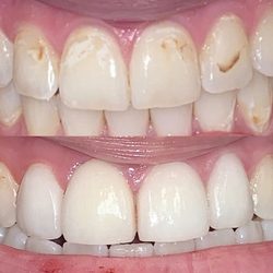 Summit Dental - Before & After