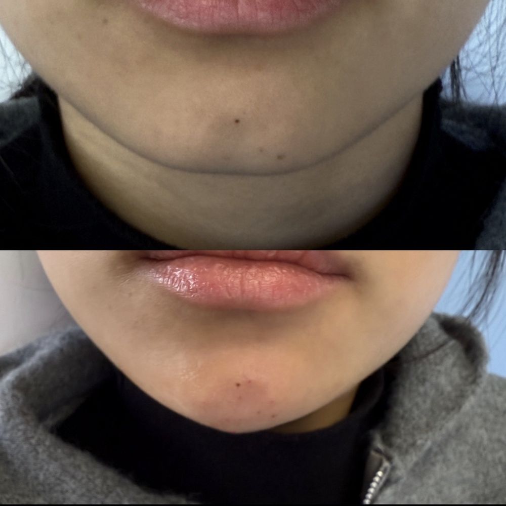 Chin Filler Chin Filler