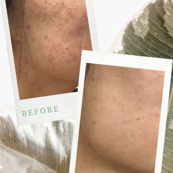 Medical Aesthetics - Acne scar removal - Aestheticians Near Me - Roseville, California Medical Aesthetics - Acne scar removal - Aestheticians Near Me - Roseville, California