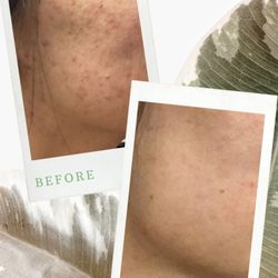 Medical Aesthetics - Acne scar removal