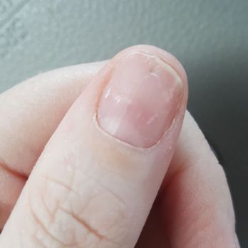 VIP Nails & Spa - Wavy brittle nail bed/deep line down the middle tip....fungus as well-- so embarrassing/sensitive painful - Nail Salons Near Me - Austin, Texas VIP Nails & Spa - Wavy brittle nail bed/deep line down the middle tip....fungus as well-- so embarrassing/sensitive painful - Nail Salons Near Me - Austin, Texas