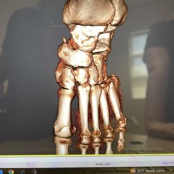 Foot And Ankle Institute - MRIshowing my Lisfrancs fracture dislocation with subluxation of the first, second and third tarsometatarsal joints creating abduction