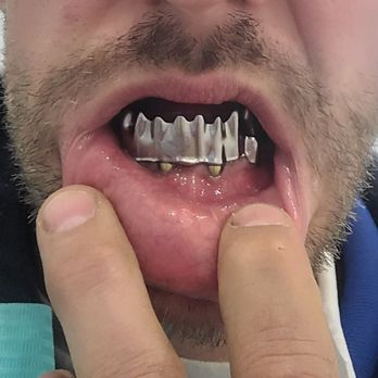 Bionic Smile - Different bar experiment - Cosmetic Dentists Near Me - Las Vegas, Nevada Bionic Smile - Different bar experiment - Cosmetic Dentists Near Me - Las Vegas, Nevada