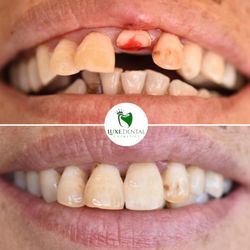 Luxe Dental Cosmetics - Emergency Dental - Same-Day Emergency Dentist in Los Angeles to treat broken tooth.