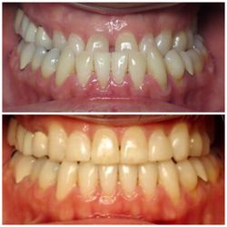 Alexa Alborzi, DDS MDS - Can you believe this was achieved with Invisalign! NOW that's something to smile about! :)