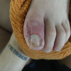Foot & Ankle Specialists of the Mid-Atlantic- Hagerstown - After the skin sloughed off.