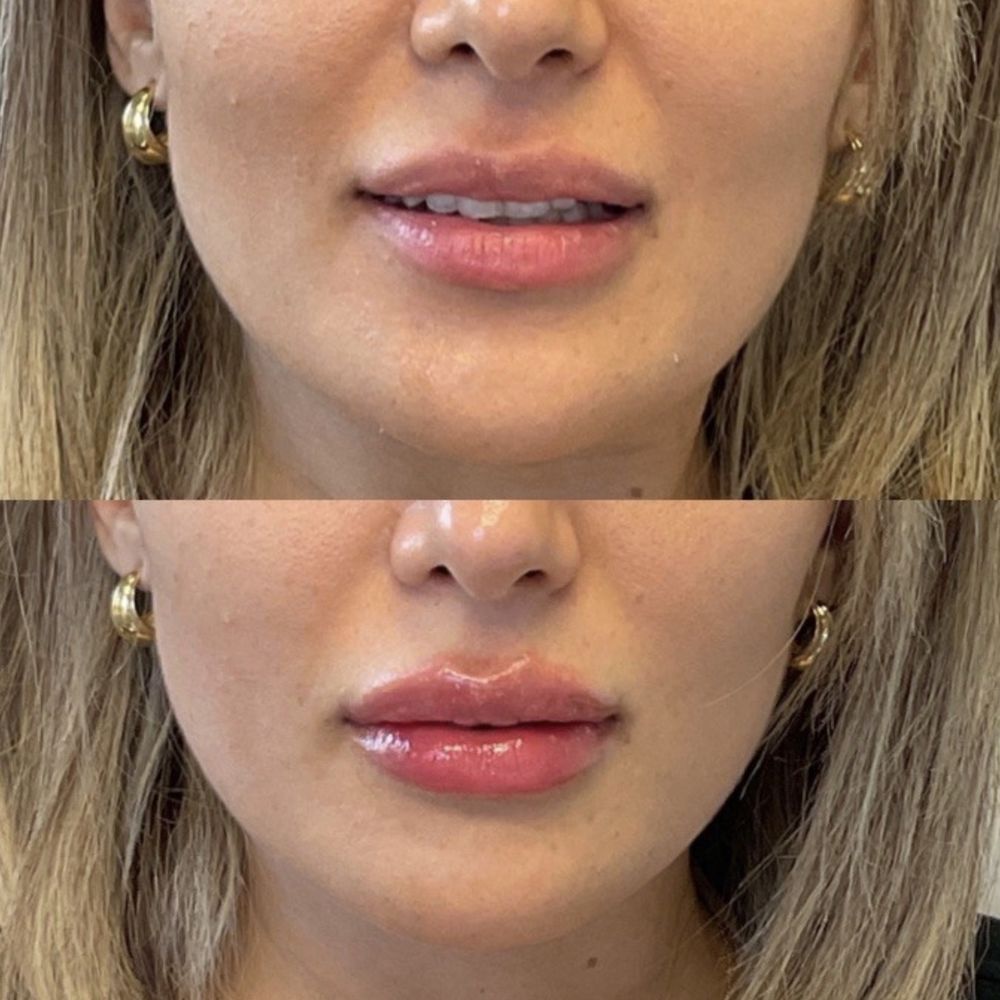 BioSpa - I'm so in love with my lips!!! Nurse Shakiba is great! 5 star - Medical Spas Near Me - Newport Beach, California BioSpa - I'm so in love with my lips!!! Nurse Shakiba is great! 5 star - Medical Spas Near Me - Newport Beach, California