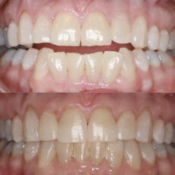 Alamo Orthodontics - The best before and after of an open bite! Come see us for all your smile needs :)