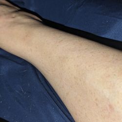 Yu Chinese Massage Therapy - Bruising from massage