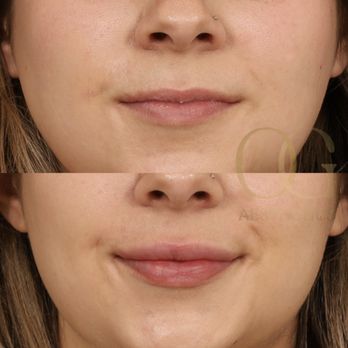OG Aesthetics - Lip Filler - Cosmetic Surgeons Near Me - Menlo Park, California OG Aesthetics - Lip Filler - Cosmetic Surgeons Near Me - Menlo Park, California