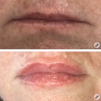 Skinjectables Anti Aging Bar - Petite lip. - Medical Spas Near Me - Tucson, Arizona Skinjectables Anti Aging Bar - Petite lip. - Medical Spas Near Me - Tucson, Arizona