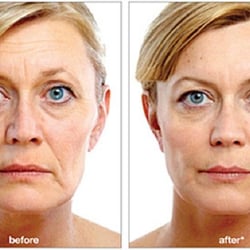 Liquid Facelift Center