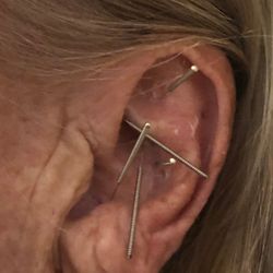ALCHEMY ACUPUNCTURE - Ear points for smoking cessation